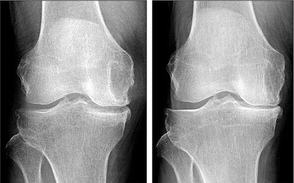 antes y después del tratamiento de la artrosis con Hondrofrost