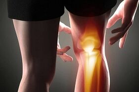 Destrucción de la articulación de la rodilla como consecuencia de la artrosis.