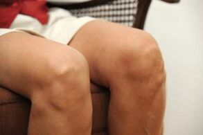 Hinchazón de la articulación de la rodilla debido a artrosis.