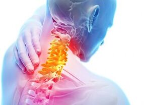 Dolor y punzadas en la zona cervical con osteocondrosis de tercer grado.