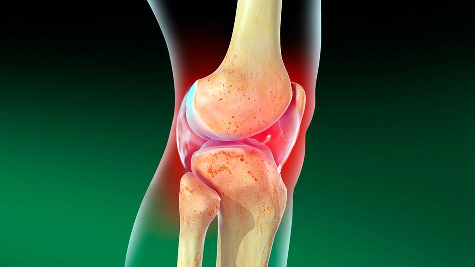 Osteoartritis de la articulación de la rodilla.