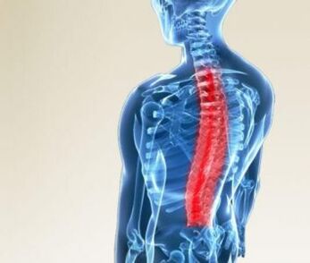 lesión de la columna vertebral en la osteocondrosis