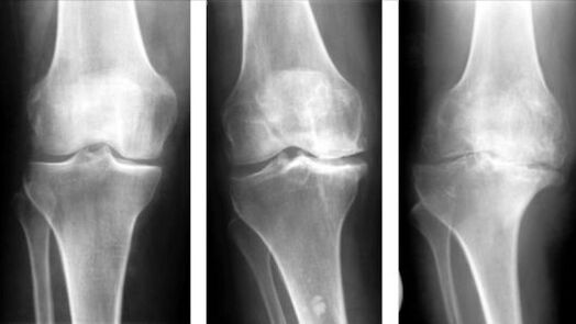 3 etapas de la artrosis de la articulación de la rodilla. 