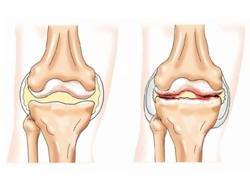 articulación de rodilla sana y enferma